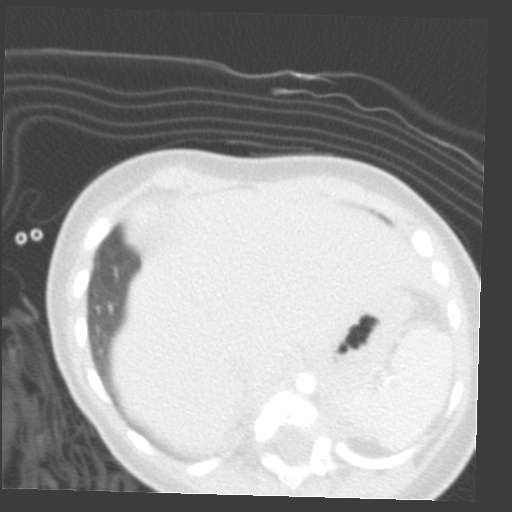 File:Aberrant left pulmonary artery (pulmonary sling) (Radiopaedia 42323-45435 Axial lung window 37).jpg