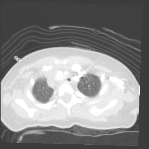 File:Aberrant left pulmonary artery (pulmonary sling) (Radiopaedia 42323-45435 Axial lung window 6).jpg