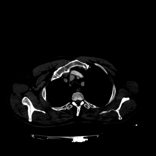 Accesory rib joint (Radiopaedia 71987-82452 Axial bone window 78).jpg