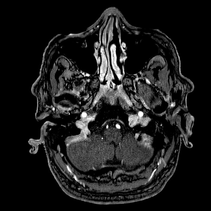 Accessory middle cerebral artery (Radiopaedia 73114-83828 Axial MRA 12).jpg