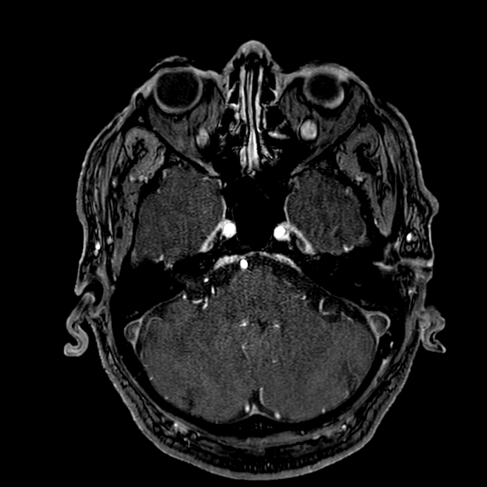 Accessory middle cerebral artery (Radiopaedia 73114-83828 Axial MRA 36).jpg