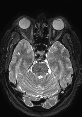 Accessory middle cerebral artery (Radiopaedia 73114-83828 Axial T2 139).jpg