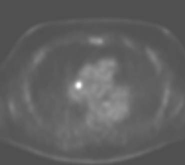 File:Accumulation of FDG in central venous catheter mimicking lymph node metastasis (Radiopaedia 63301-71878 Axial PET 1).PNG