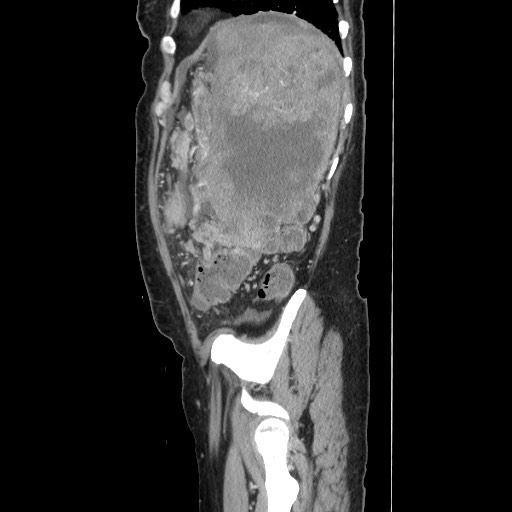 Acinar cell carcinoma of the pancreas (Radiopaedia 75442-86669 Sagittal C+ portal venous phase 153).jpg
