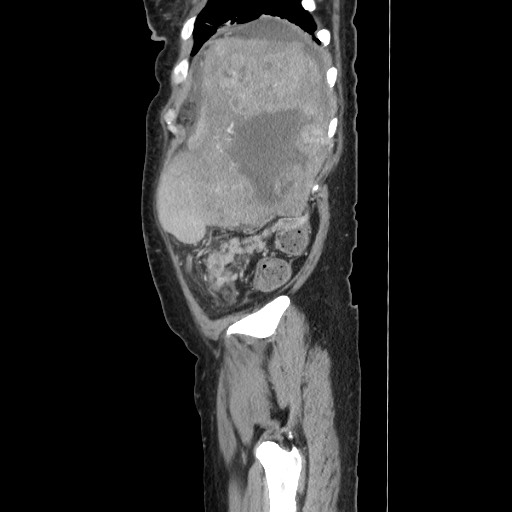 Acinar cell carcinoma of the pancreas (Radiopaedia 75442-86669 Sagittal C+ portal venous phase 163).jpg