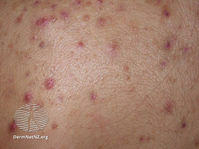 File:Acne affecting the back images (DermNet NZ acne-acne-back-181).jpg