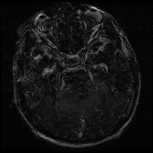 File:Acoustic schwannoma (Radiopaedia 39170-41387 Axial FIESTA 107).png