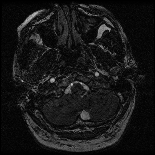 File:Acoustic schwannoma (Radiopaedia 39170-41387 Axial FIESTA 18).png