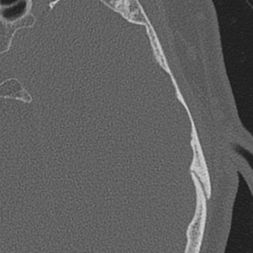 Acoustic schwannoma - cystic (Radiopaedia 29487-29980 AXIAL LEFT bone window 55).jpg