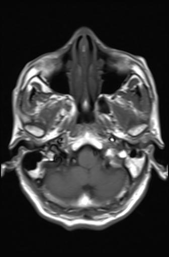 File:Acoustic schwannoma - probable (Radiopaedia 20386-20292 Axial T1 3).jpg