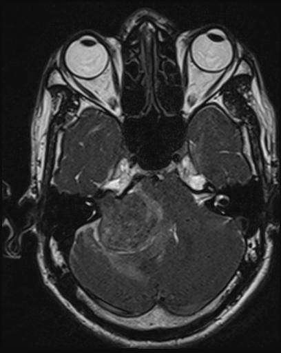 File:Acoustic schwannoma - probable (Radiopaedia 20386-20292 Axial T1 40).jpg