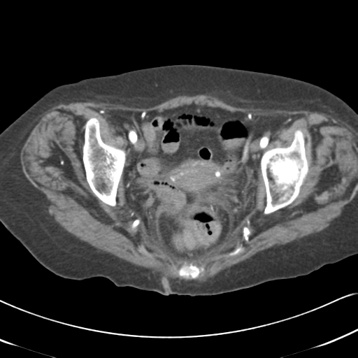 File:Active bleeding from duodenal ulcer with embolization (Radiopaedia 34216-35481 Axial C+ arterial phase 59).png