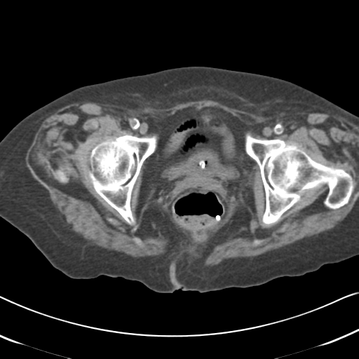 Active bleeding from duodenal ulcer with embolization (Radiopaedia 34216-35481 Axial non-contrast 65).png
