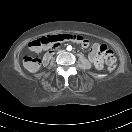 Active bleeding from duodenal ulcer with embolization (Radiopaedia 34216-35481 C 35).png