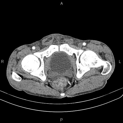 Active crohn disease (Radiopaedia 87133-103397 Axial C+ arterial phase 100).jpg
