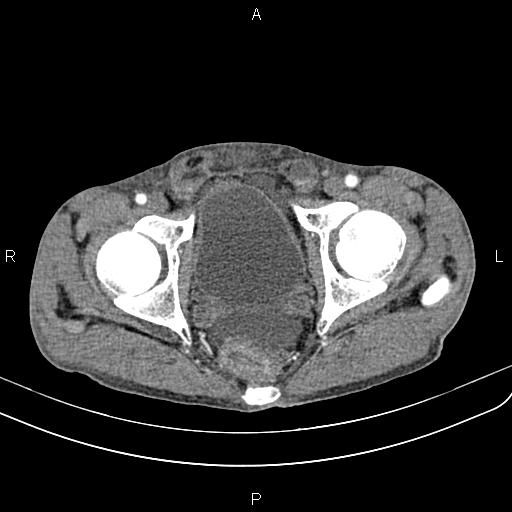 Active crohn disease (Radiopaedia 87133-103397 Axial C+ arterial phase 97).jpg