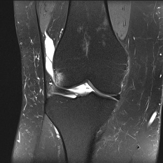File:Acute-on-chronic transient lateral patellar dislocation with trochlear dysplasia (Radiopaedia 84099-99349 Coronal PD fat sat 23).jpg