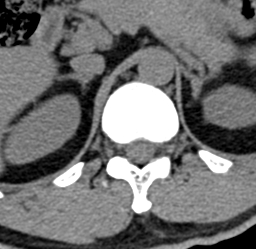 File:Acute L1 burst compression fracture (Radiopaedia 34430-35755 Axial non-contrast 5).png