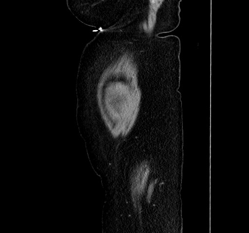 Acute appendicitis, heterotaxy syndrome (Radiopaedia 66884-76202 Sagittal C+ portal venous phase 121).jpg
