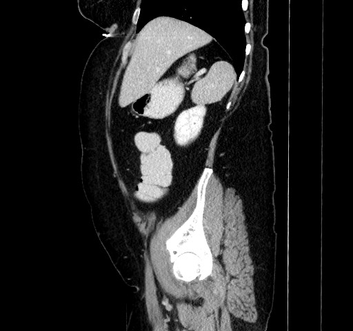 Acute appendicitis, heterotaxy syndrome (Radiopaedia 66884-76202 Sagittal C+ portal venous phase 39).jpg
