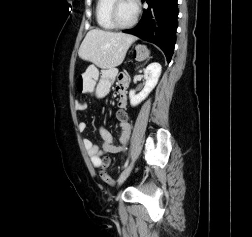 Acute appendicitis, heterotaxy syndrome (Radiopaedia 66884-76202 Sagittal C+ portal venous phase 87).jpg