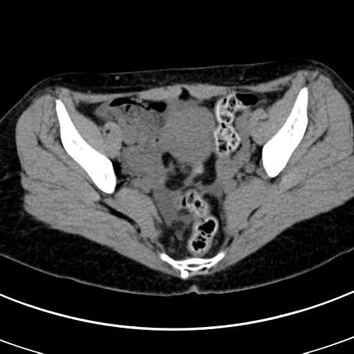 Acute appendicitis (Radiopaedia 30261-30888 Axial non-contrast 88).jpg