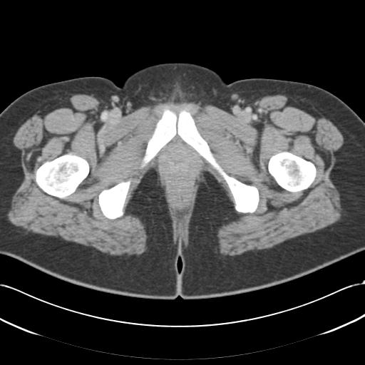File:Acute appendicitis (Radiopaedia 30297-30934 Axial C+ portal venous phase 86).jpg