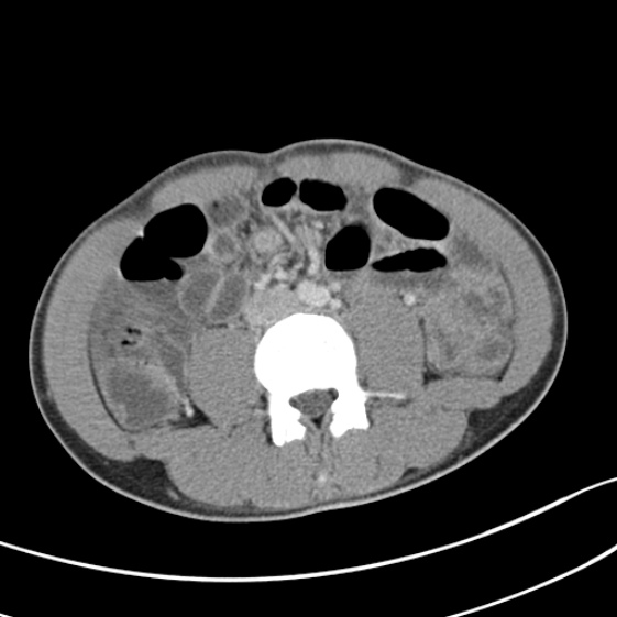 File:Acute appendicitis (Radiopaedia 32614-33572 Axial C+ portal venous phase 36).jpg