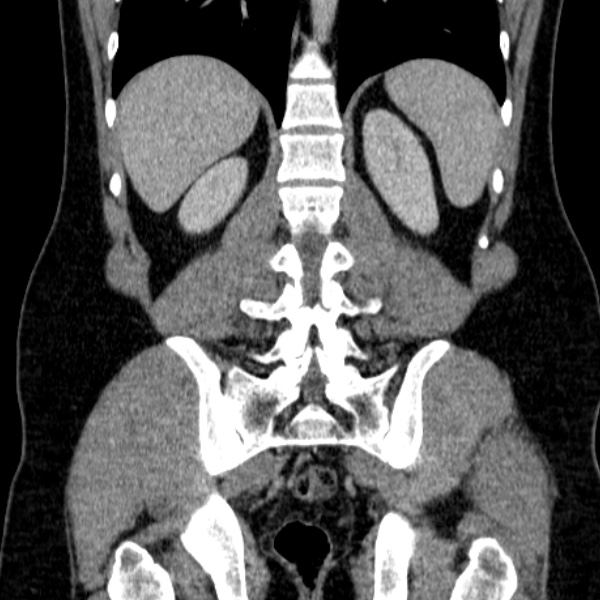 Acute appendicitis (Radiopaedia 38255-40270 Coronal C+ portal venous phase 63).jpg