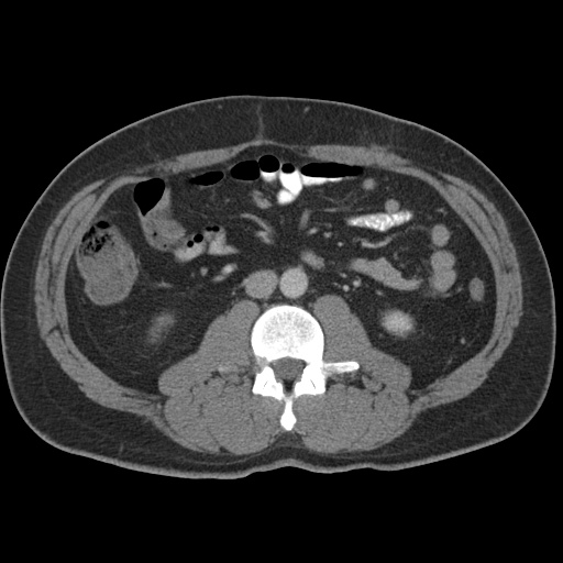 Acute appendicitis (Radiopaedia 48511-53463 Axial C+ portal venous phase 51).jpg