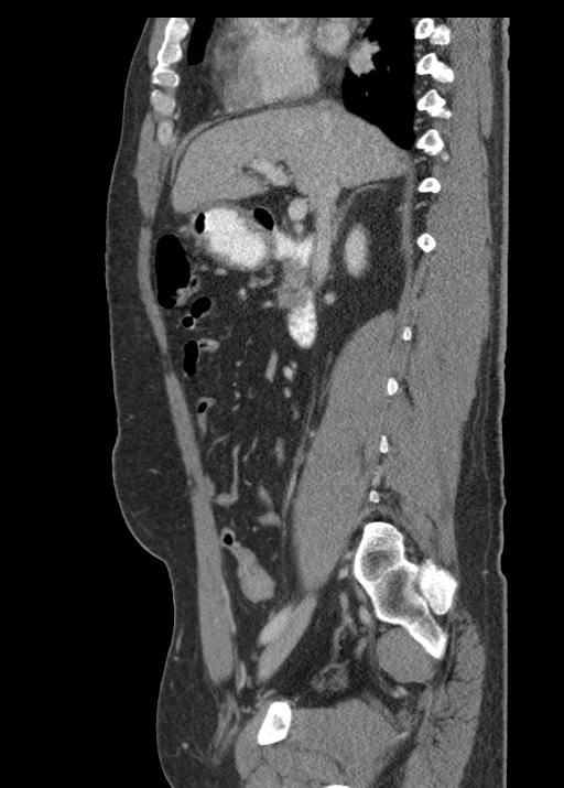 Acute appendicitis (Radiopaedia 48511-53463 Sagittal C+ portal venous phase 60).jpg