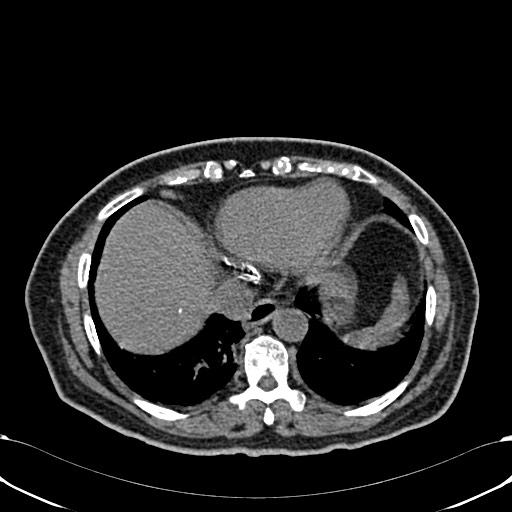 Acute appendicitis (Radiopaedia 58627-65818 Axial non-contrast 10).jpg
