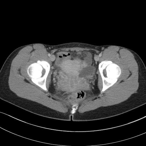File:Acute appendicitis (Radiopaedia 62608-70901 Axial C+ portal venous phase 50).jpg
