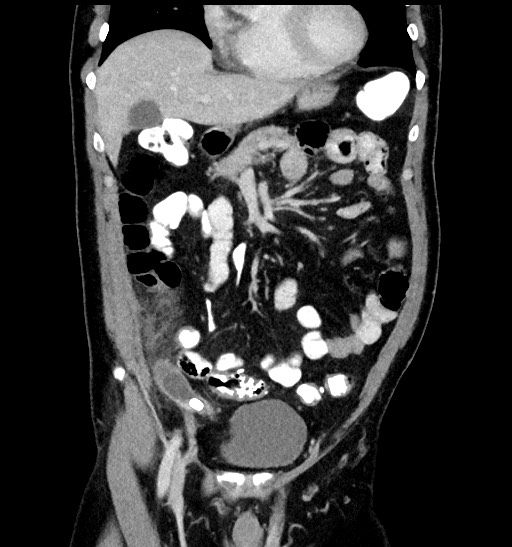 Acute appendicitis (Radiopaedia 77016-88960 Coronal C+ portal venous phase 38).jpg