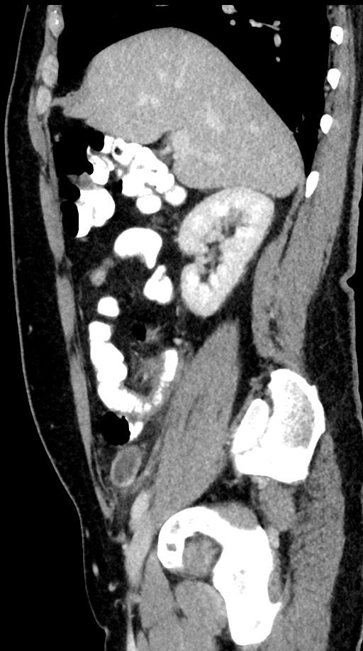 Acute appendicitis (Radiopaedia 77016-88960 Sagittal C+ portal venous phase 78).jpg