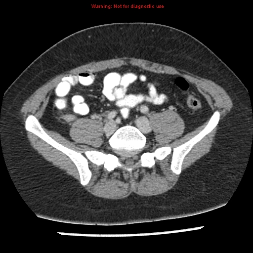 Acute appendicitis (Radiopaedia 7966-8812 C+ portal venous phase 35).jpg