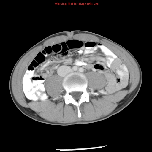 Acute appendicitis (Radiopaedia 8195-9045 Axial C+ portal venous phase 43).jpg