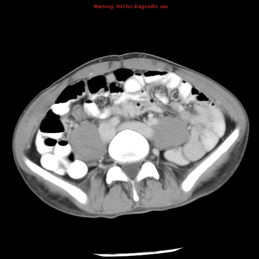 Acute appendicitis (Radiopaedia 8195-9045 Axial C+ portal venous phase 48).jpg