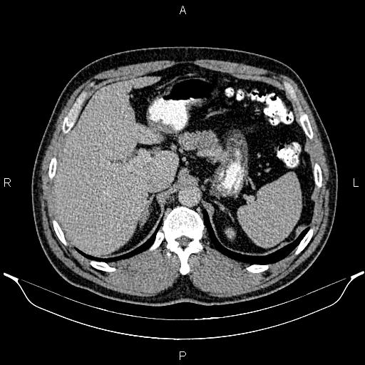 Acute appendicitis (Radiopaedia 84780-100240 Axial C+ portal venous phase 26).jpg
