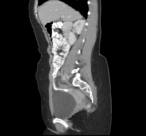 File:Acute appendicitis (Radiopaedia 9417-10099 Sagittal C+ portal venous phase 7).jpg