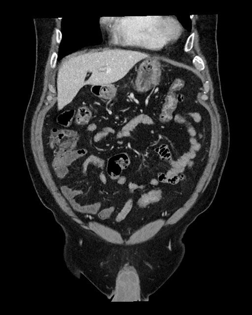 Acute appendicitis - large appendicoliths (Radiopaedia 61805-69820 Coronal C+ portal venous phase 39).jpg