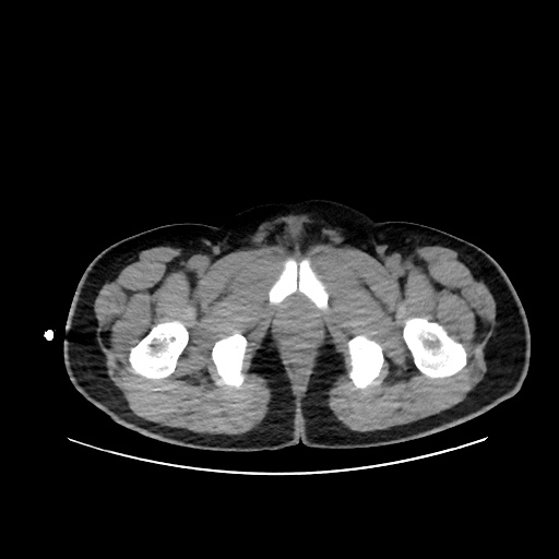 Acute appendicitis and COVID 19 pneumonia (Radiopaedia 76604-88380 Axial non-contrast 125).jpg