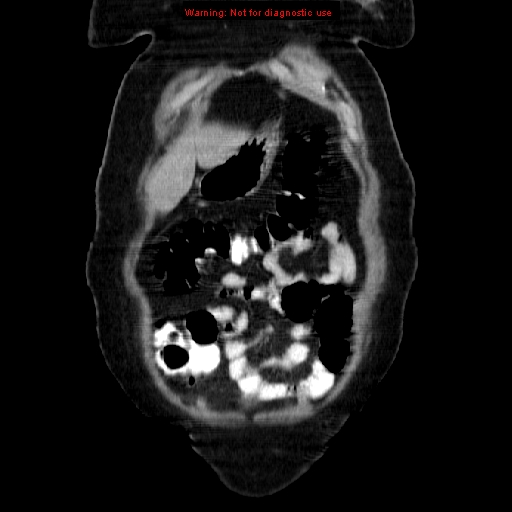 Acute appendicitis complicated by ovarian vein thrombophlebitis (Radiopaedia 16172-15851 Coronal C+ portal venous phase 17).jpg