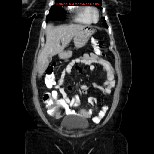 Acute appendicitis complicated by ovarian vein thrombophlebitis (Radiopaedia 16172-15851 Coronal C+ portal venous phase 25).jpg