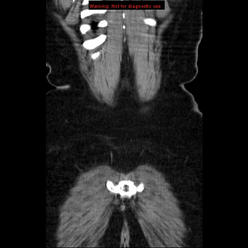File:Acute appendicitis complicated by ovarian vein thrombophlebitis (Radiopaedia 16172-15851 Coronal C+ portal venous phase 77).jpg
