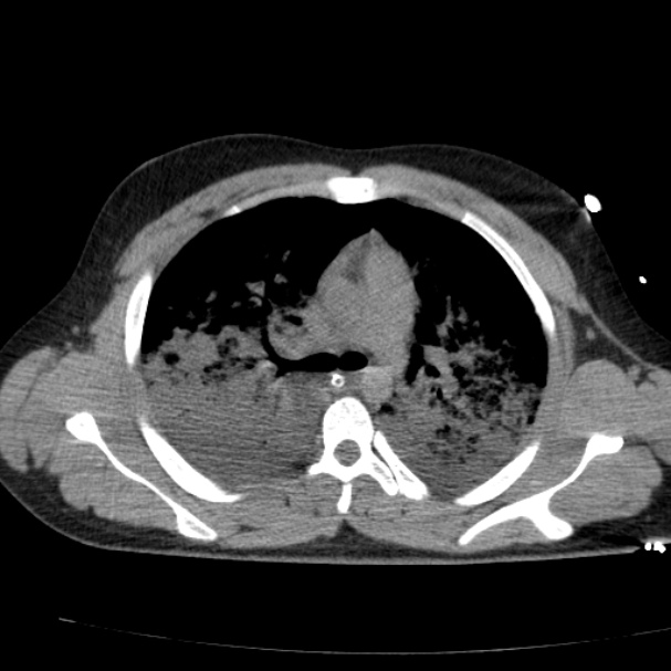 Acute aspiration pneumonitis (Radiopaedia 33605-34703 Axial non-contrast 39).jpg