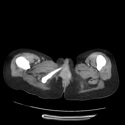 Acute calculous cholecystitis in patient with osteopetrosis (Radiopaedia 77871-90159 Axial C+ portal venous phase 86).jpg