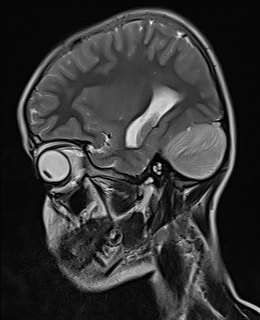 File:Acute cerebellar ataxia (Radiopaedia 61487-69446 Sagittal T2 11).jpg