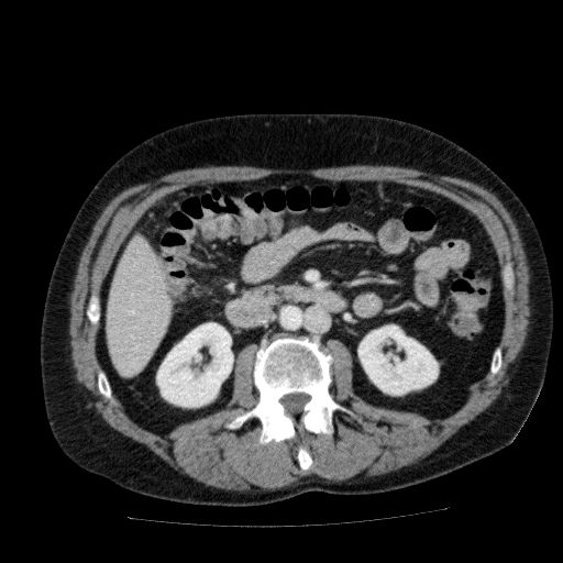 Acute cholecystitis and incidental left sided IVC (Radiopaedia 49352-54459 Axial C+ portal venous phase 72).jpg