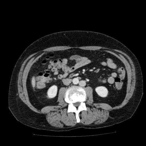 Acute cholecystitis and incidental left sided IVC (Radiopaedia 49352-54459 Axial C+ portal venous phase 81).jpg